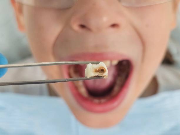 Best Emergency Dentist for Lost Fillings or Crowns in Chena Ridge, AK